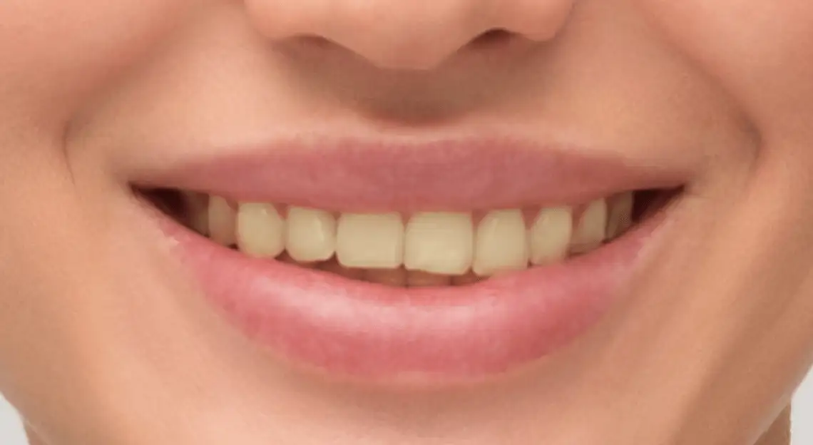 Antes — Clareamento Dental