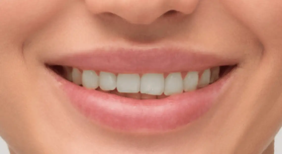 Depois — Clareamento Dental